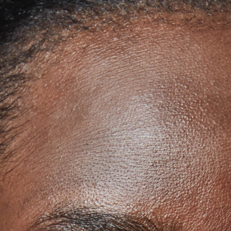 Dry and Dehydrated Skin