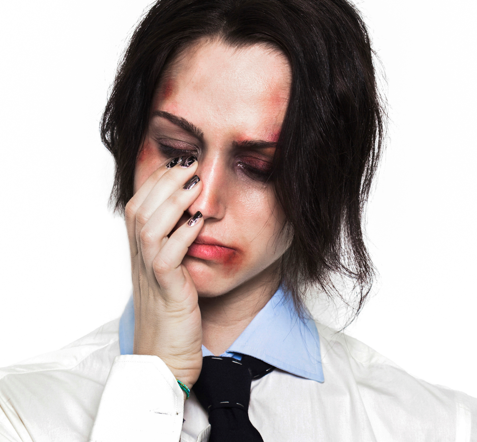 Woman with facial bruising after an assault